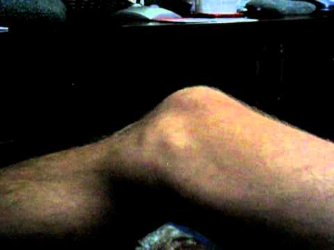 fasciculations als leg muscle disease