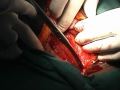 Total Abdominal Hysterectomy: Incision and opening of the pelvic cavity