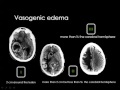 Imaging of Brain tumors   Prof Dr  Mamdouh Mahfouz In Arabic