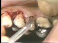 Periodontal Surgery (Muco-Periosteal Flap)