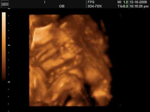 3d ultrasound pictures at 26 weeks. 26 week 3d/4d ultrasound