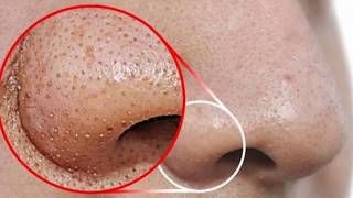 ब्लैकहेड्स और वाइटहेड्स को सिर्फ 5 मिनट में हमेशा के लिए हटाए | Remove Blackheads & Whiteheads 100%