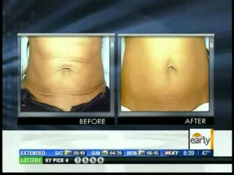 Ultrasound Fat Reduction