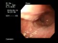 TÚI THỪA LỚN THỰC QUẢN ĐOẠN 1/3 DƯỚI , SÁT LỖ TÂM VỊ