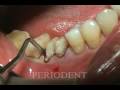 Molar Extraction and Immediate Implant Placement