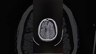 Chronic Subdural Hematoma