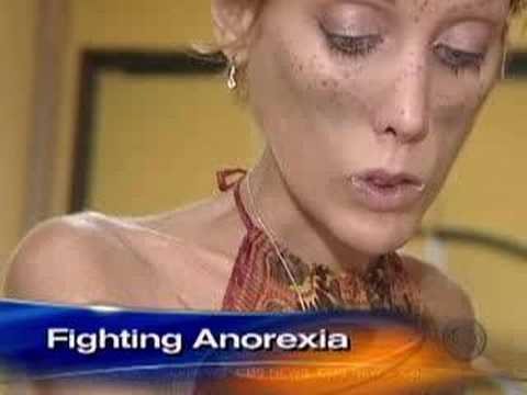 Anorexia's Childhood Roots CBS News 