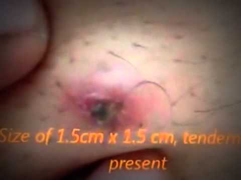 Sebaceous Cyst Abdomen - YouTube