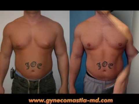 Cristiano Ronaldo Shirtless on Gynecomastia   Dr Mordcai Blau   Body Builders   Male Breast Reduction