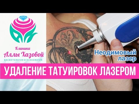 Обучение лазер для удаления татуажа Обучение лазер для удаления татуажа