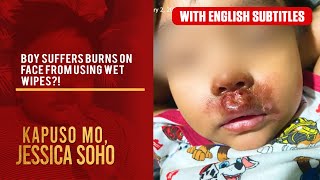 Boy Suffers Burns On Face From Using Wet Wipes? With English Subs Kapuso Mo, Jessica Soho