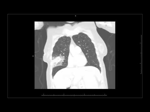 lung pneumonia chest ray cancer robotic mass