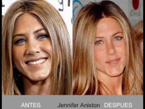 Blefaroplastia antes y despues - YouTube Blefaroplastia antes y despues - YouTube
