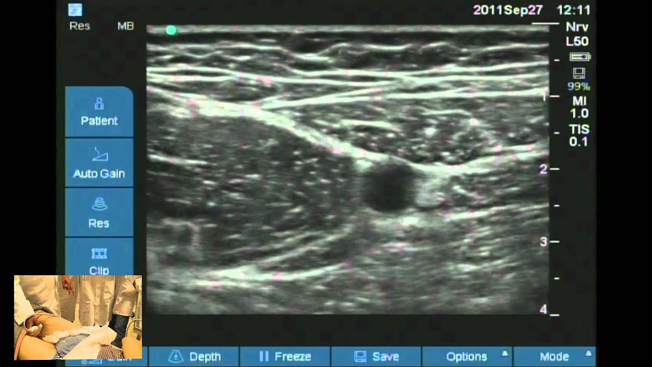 Ultrasound guided obturator and saphenous nerve block workshop - YouTube