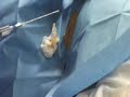 hepatic biopsy