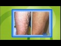 Varicose Vein Treatments in Largo, FL Solve Other Leg Ailments