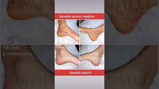 Dermatoloq Mehdi İskəndərli Ayaqda Qızartı