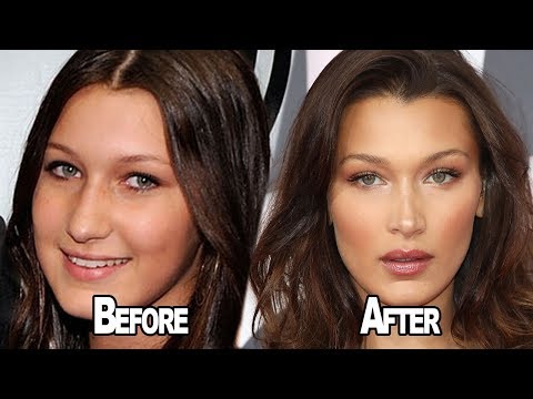 Bella Hadid OPENS UP About Having Plastic Surgery!