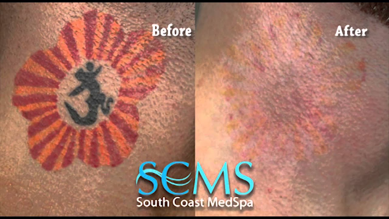 Laser Tattoo Removal-Color Tattoo (Before/After Photos) - YouTube