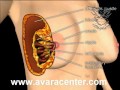 breast lift عملية شد الثدي و تجميل الثدي