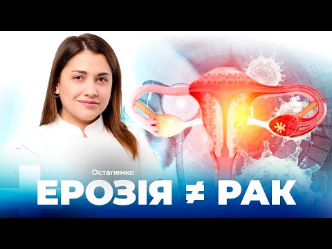 Ерозія шийки матки: причини, лікування, профілактика