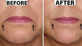 How To Reverse Frowning & Fix Your Smile