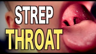 Strep Throat: LIVE DIAGNOSIS Strep Throat: LIVE DIAGNOSIS