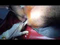 Anal / Rectal foreign body | surgical removal of foreign rectal foreign body | medico mnemonico