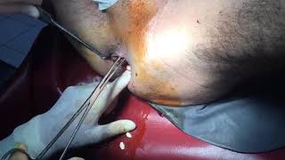 Anal / Rectal foreign body | surgical removal of foreign rectal foreign body | m