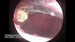 Tonsilolith Removal