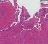 crohns disease - differential diagnosis crohns disease - differential diagnosis