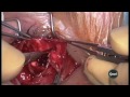 evisceration