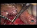evisceration