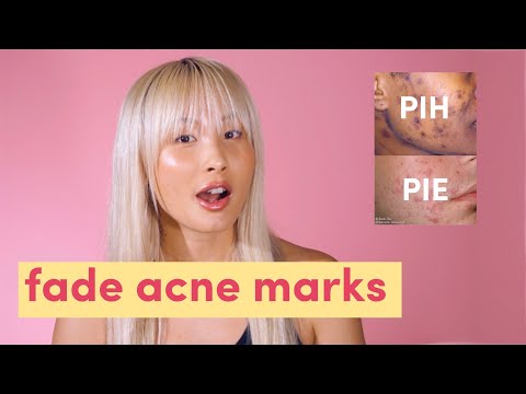 Fade acne marks! Post inflammatory hyperpigmentation & post inflammatory erythema  | PIH & PIE - YouTube