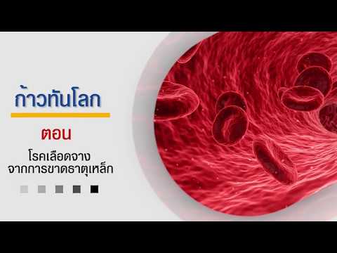 ก้าวทันโรค ตอนที่ 33 - โรคเลือดจางจากการขาดธาตุเหล็ก (นพ. กิตติไกร ไกรแก้ว)