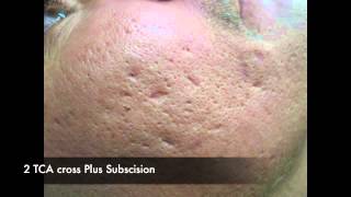 Laser tattoo removal poughkeepsie ny news