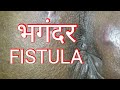 भगंदर की पूरी जानकारी हिंदी में - FISTULA IN ANO