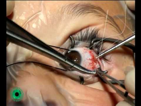 as can i model teen strabismus surgery for adults
