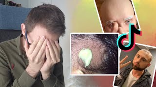 DERMATÓLOGO REACCIONA VÍDEOS CALVICIE y TRASPLANTE CAPILAR