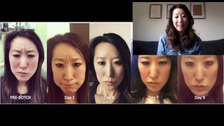 Botox Faqs