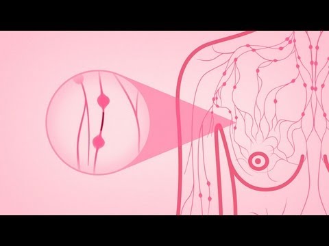 Ibc breast cancer video
