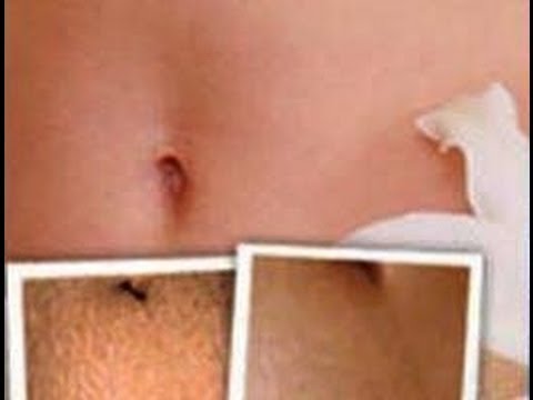Permanently Remove Stretch Marks Naturally Permanently Remove Stretch Marks Naturally
