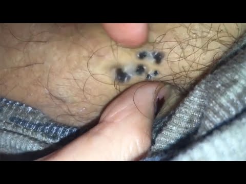 DPOWs - Dilated Pores with Mystery DPOW