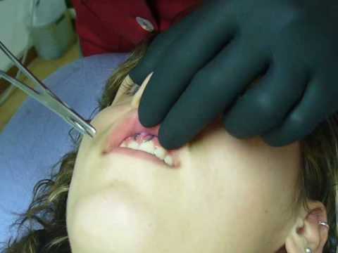 ACERO Y PIEL - aka-gum piercing frenillo labio superior ACERO Y PIEL - aka-gum piercing frenillo labio superior