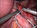 hernioplastia