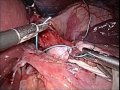 hernioplastia