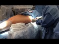 Femoral Shaft Fracture Intramedullary Nailing (Femur Fracture Surgery)