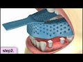 Dental implants procedure video - restoration