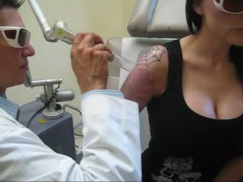 This is the work in progress of Dahlia Dark's laser tattoo removal treatment 