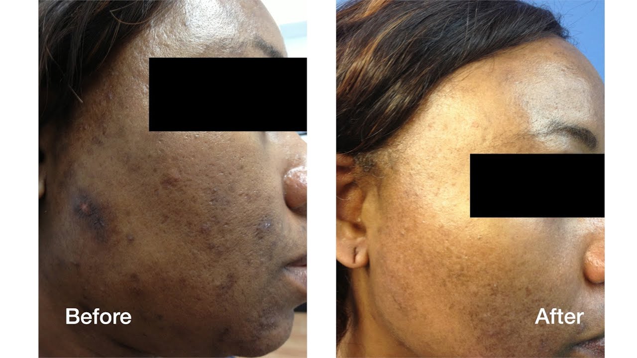 Dark Skin Laser Skin Care Treatments | Skin Perfect ...
